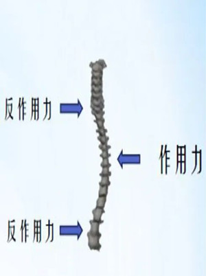 什么是脊柱側(cè)彎矯形器？