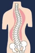 脊柱側(cè)彎的原因