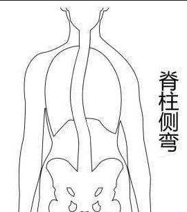 脊柱側(cè)彎康復訓練主要從四個方面入手！